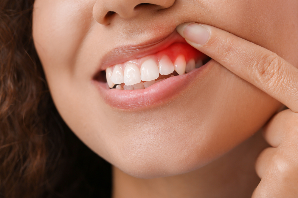 how to prevent and treat gum boils?