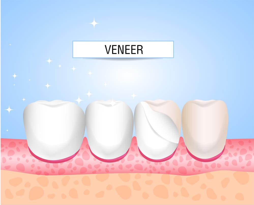 porcelain veneers in Livonia